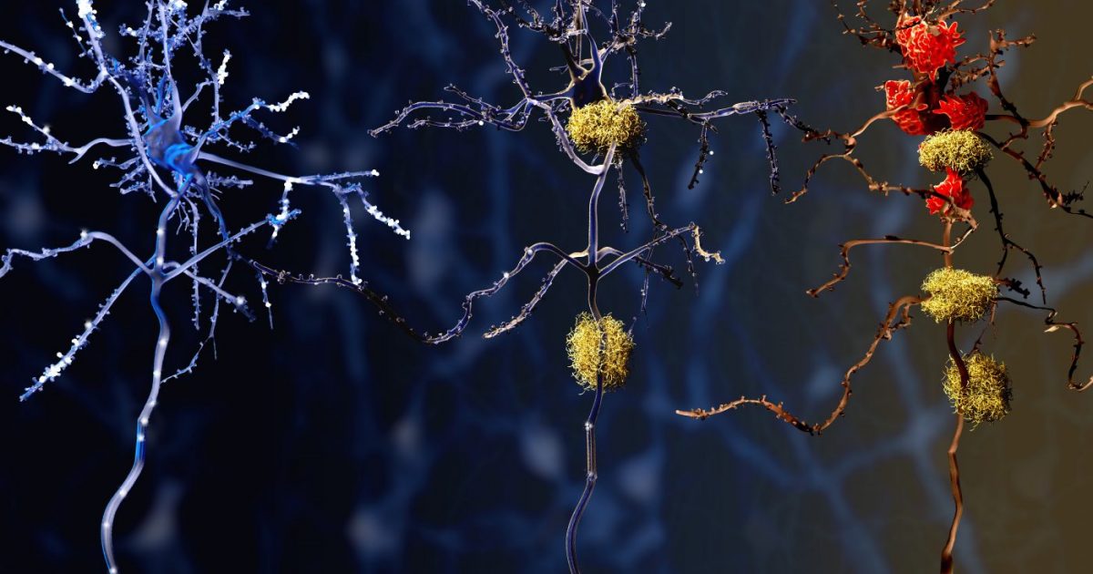 The Molecular Mechanism: How Lipids Drive Neurodegeneration