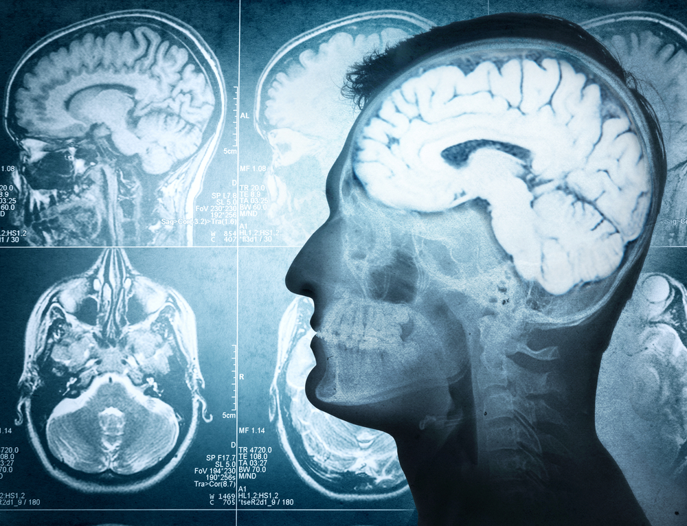 Parkinson's and neurodegeneration