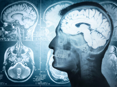 plaque and dementia