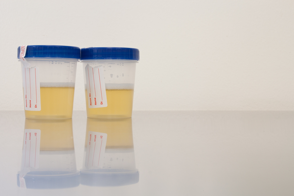 Parkinson's protein in patient urine