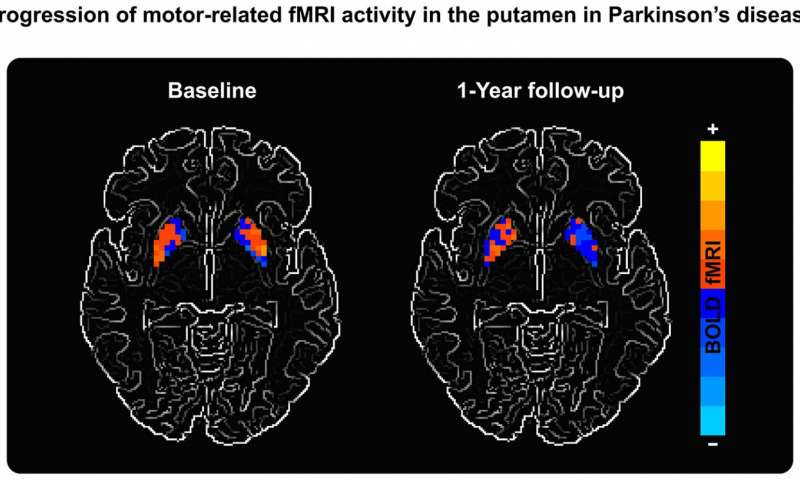 Parkinson's patient scan in UF study