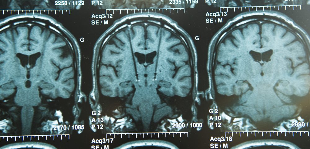 MRI in Parkinson's Patients Showed High Iron Levels in the Brain