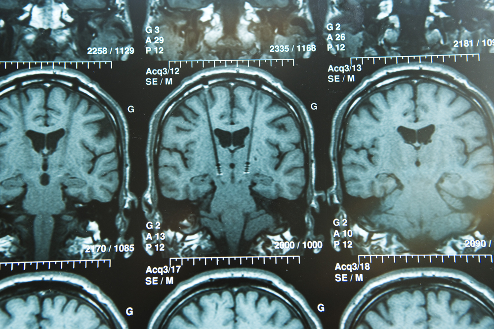 MRI in Parkinson's