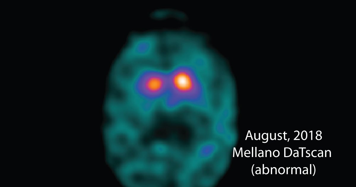 My DaTscan Results Made My PD Diagnosis 'Real'
