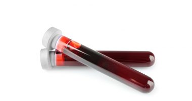 blood cholesterol with GBA mutations/Parkinson's News Today/blood samples in testtubes