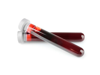 blood cholesterol with GBA mutations/Parkinson's News Today/blood samples in testtubes