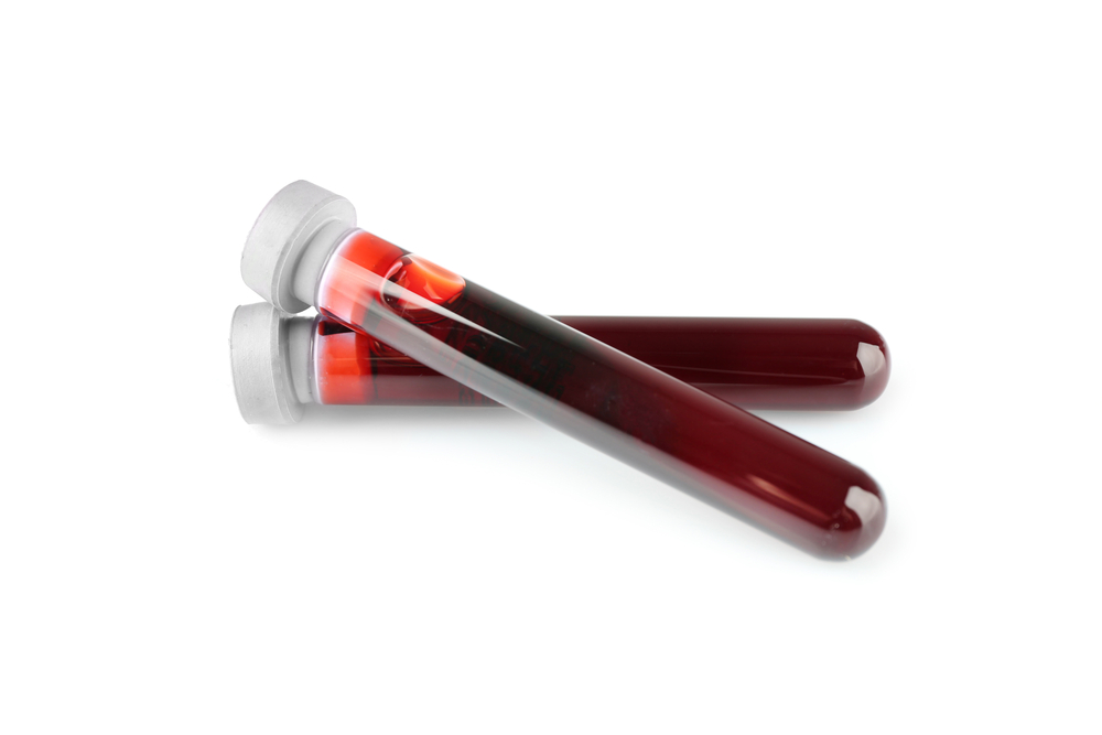 blood cholesterol with GBA mutations/Parkinson's News Today/blood samples in testtubes
