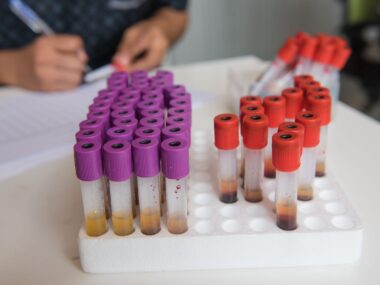 blood tests as diagnostic aid