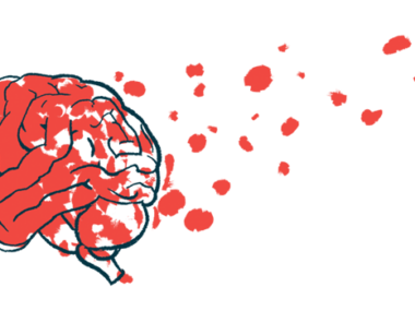 An illustration of a brain with Alzheimer's disease.