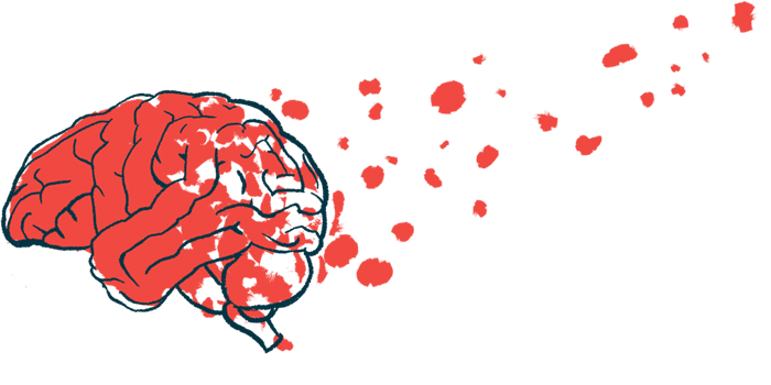 An illustration of a brain with Alzheimer's disease.