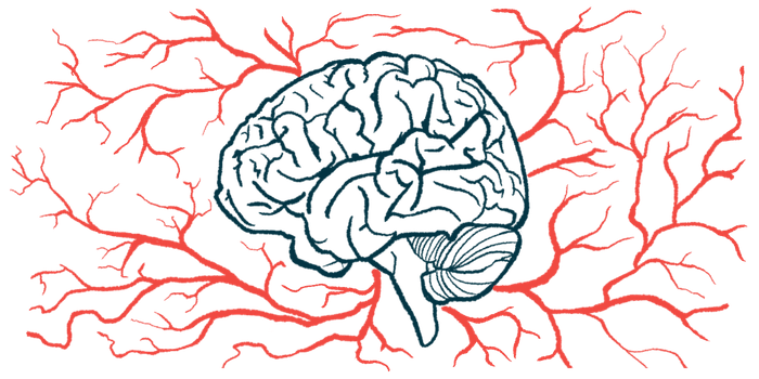 deep brain stimulation Parkinson's | Parkinson's News Today | mania due to DBS treated | illustration of human brain