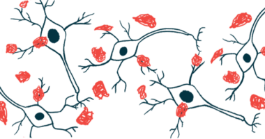 An illustration provides a close-up view of protein clumps known as amyloid plaques, that are a hallmark of Alzheimer's disease.