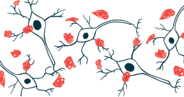 Amyloid plaques are shown on nerve cells.