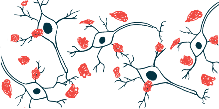 Amyloid plaques are shown on nerve cells.