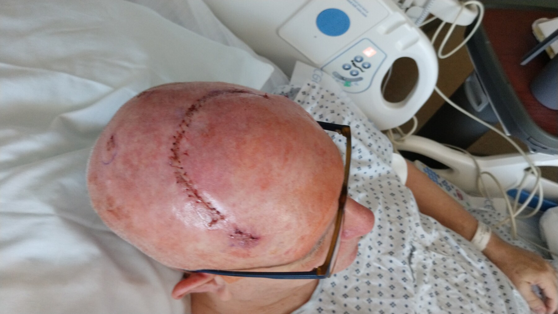 A photo taken from a high angle looks down on a man's head. He is bald and has a fresh curved incision across the top of his head. He's wearing glasses and a hospital gown and is lying in a hospital bed.