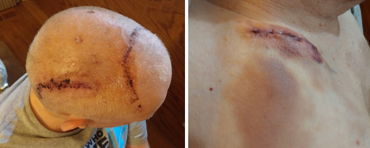 Two side-by-side photos show a man's incisions after deep brain stimulation surgery. In the left photo, we see a fresh incision on the right side of his head, behind his ear, in addition to the one from a week earlier that arcs across the top of his head. There are also several anchors visible on his head. The second photo shows a raised incision on the man's chest where a neurostimulator was implanted.