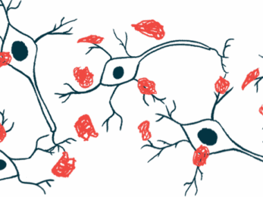 An illustration of plaques damaging nerve cells.