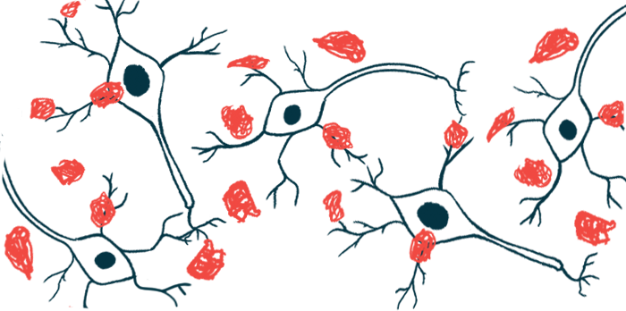 An illustration of plaques damaging nerve cells.