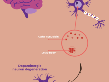 Illustration of a brain and cells to show how Parkinson's develops.